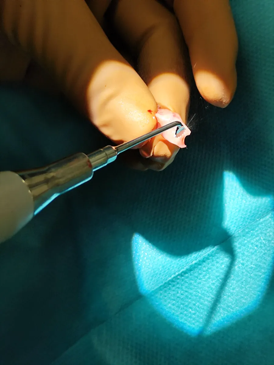 Shaping cartilage with the Piezosurgery Flex ultrasonic device during surgery