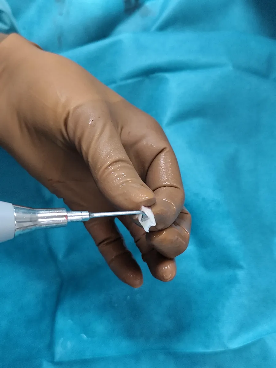 Precision use of the Piezosurgery Flex ultrasonic tip with a cartilage graft